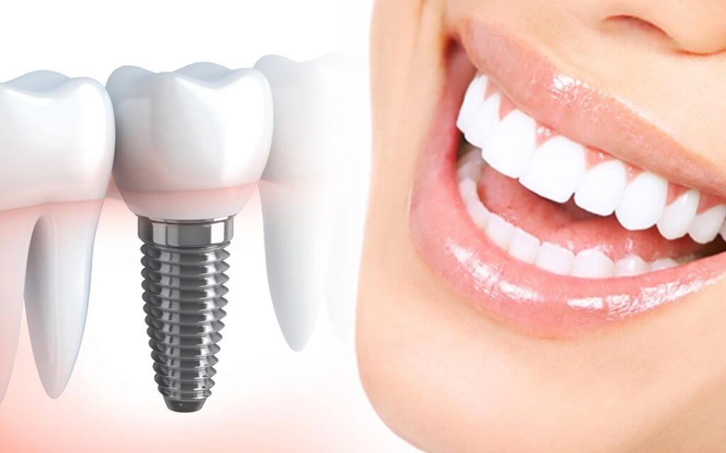 implant